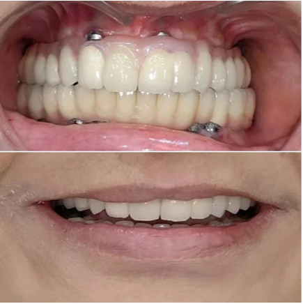 before and after dental smile makeover comparison, professional photography