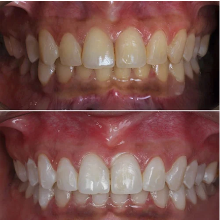 before and after dental crowns treatment comparison, professional photography