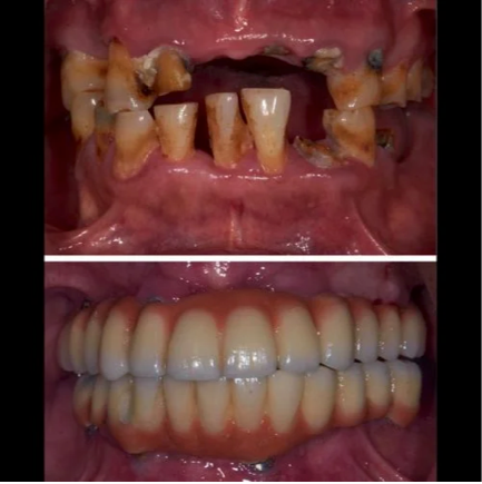 before and after dental implant treatment comparison, professional photography